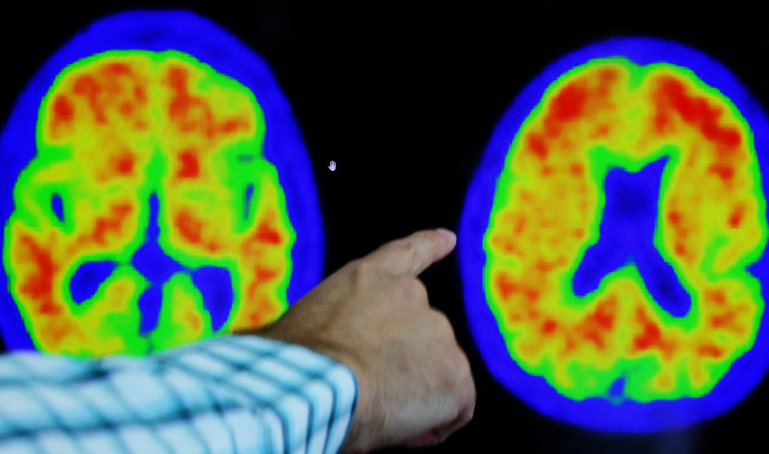 FILE PHOTO: Evidence of Alzheimer’s disease on PET scans at the Center for Alzheimer Research and Treatment in Boston
